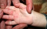 Bakıda suçiçəyinə bənzər virus yayılıb