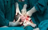 Qeysəriyyə əməliyyatının sonu faciə ilə bitdi:daha bir ana ölümü