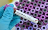 Azərbaycanda daha 471 nəfər koronavirusa yoluxdu