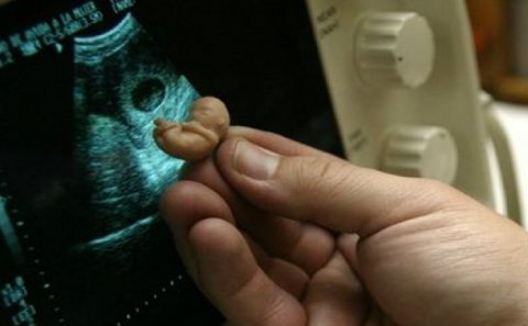 Məktəbli qızları aborta aparan -SƏBƏB