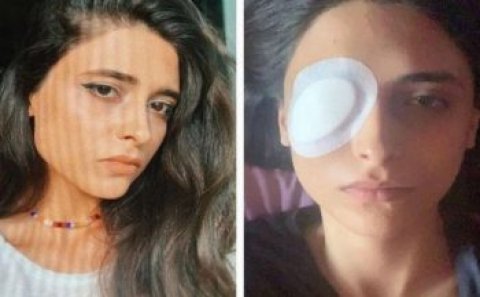 Bakıda lazer epilyasiyasında qızın gözünü zədələdilər – Kor olacaqdı – FOTO