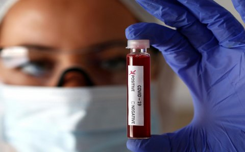 Azərbaycanda daha 76 nəfər koronaya yoluxdu: ölən var